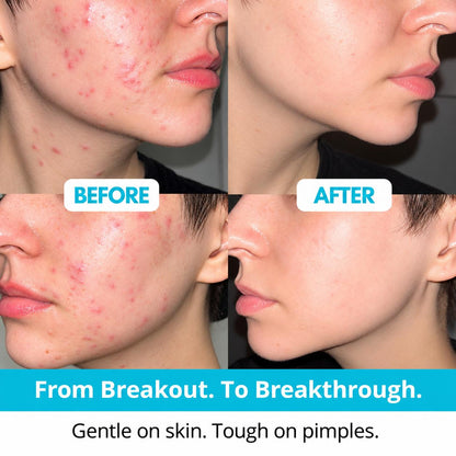 Hydrocolloid Pimple Patch Roll